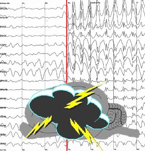 Epilepsia 2obr